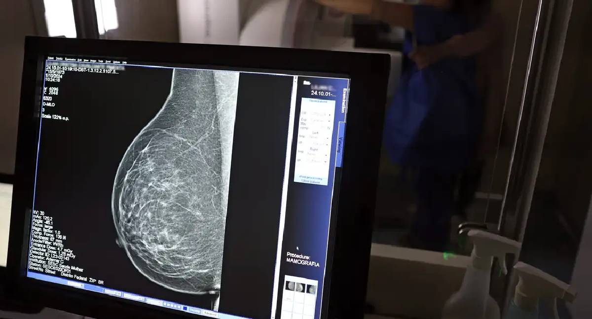 Ministério da Saúde muda e recomenda mamografia aos 40 anos