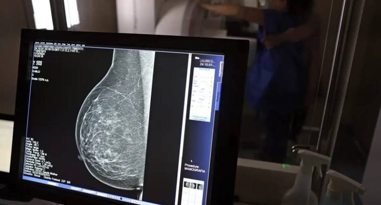 Disparidade na mamografia limita prevenção do câncer de mama no Brasil