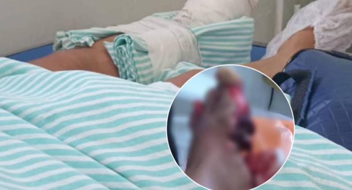 Mulher fica com pé lacerado em acidente entre moto e carro no centro de Vilhena