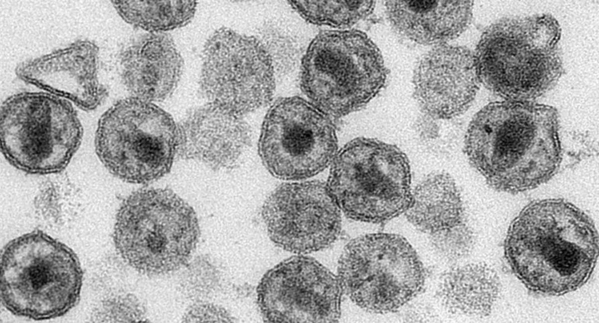 Cientistas alemães descobrem anticorpo eficaz contra o HIV