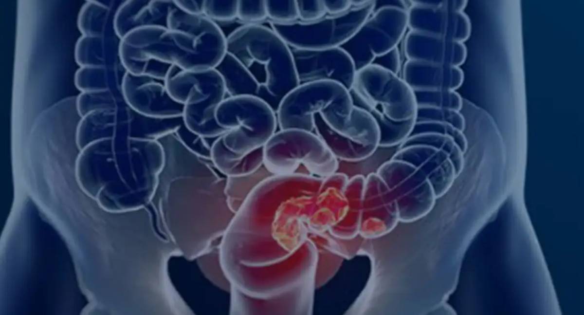 Diagnóstico tardio de câncer colorretal atinge 60% dos pacientes no Brasil