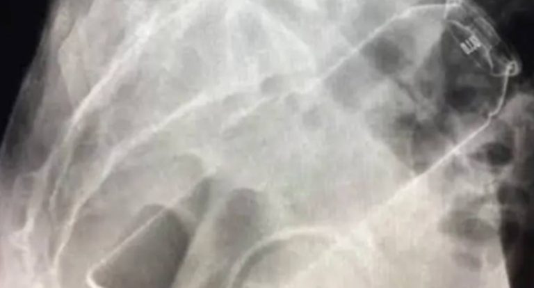 Homem procura hospital após frasco de desodorante ficar preso no ânus