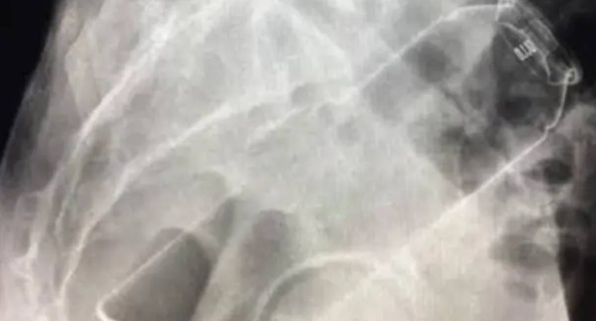 Homem procura hospital após frasco de desodorante ficar preso no ânus