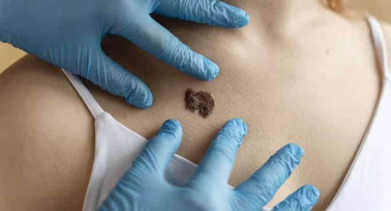 IA detecta câncer de pele agressivo com 94,5% de precisão, aponta estudo