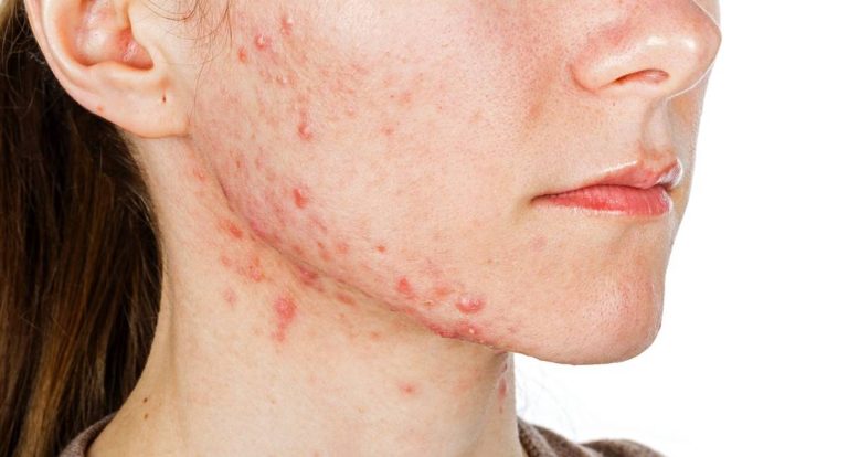 Acne adulta cresce entre mulheres e exige cuidado contínuo