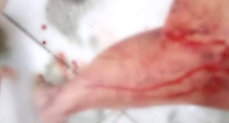 Homem fica ferido ao cair sobre faca durante discussão em RO