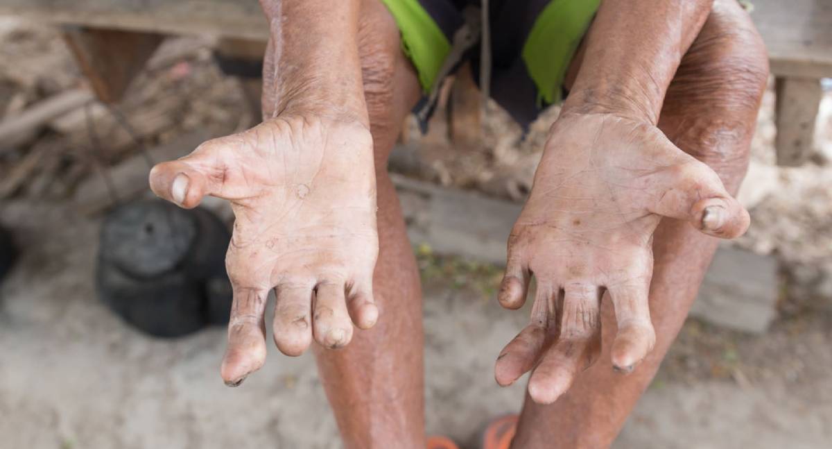 Janeiro Roxo alerta para hanseníase em Rondônia