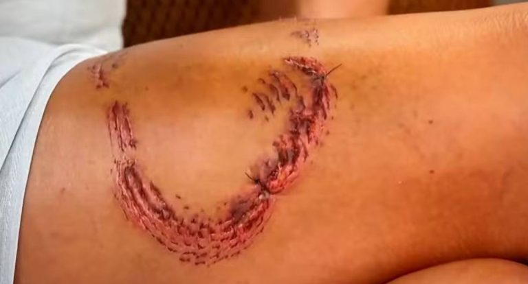 Turista detalha ataque de tubarão em Fernando de Noronha