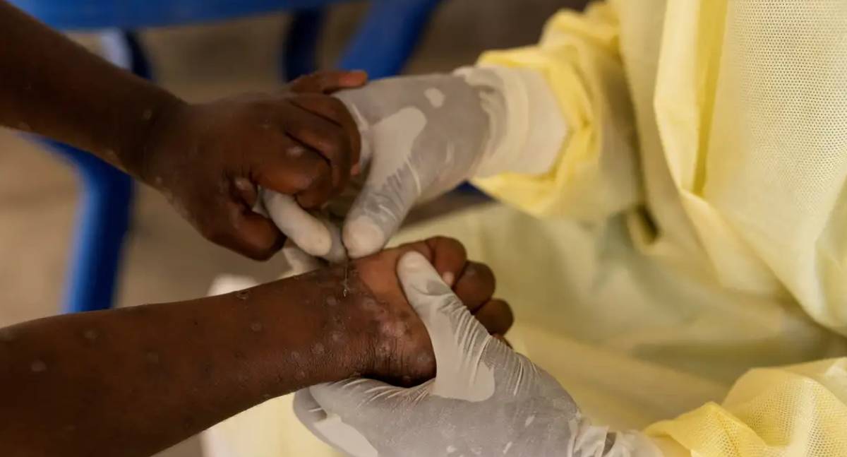 Brasil registra 88 casos de Mpox nos dois primeiros meses de 2026