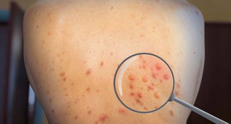 Brasil registra mais de 50 casos de varíola do macaco