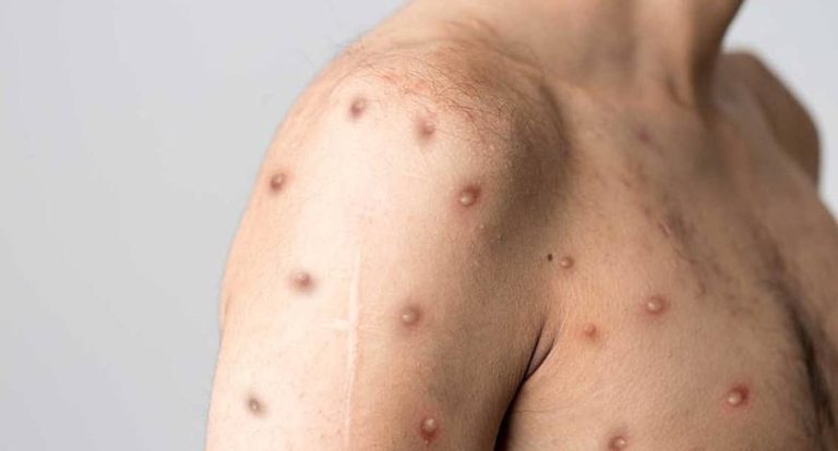 Prefeitura de Jaru orienta população em casos de suspeita de Mpox