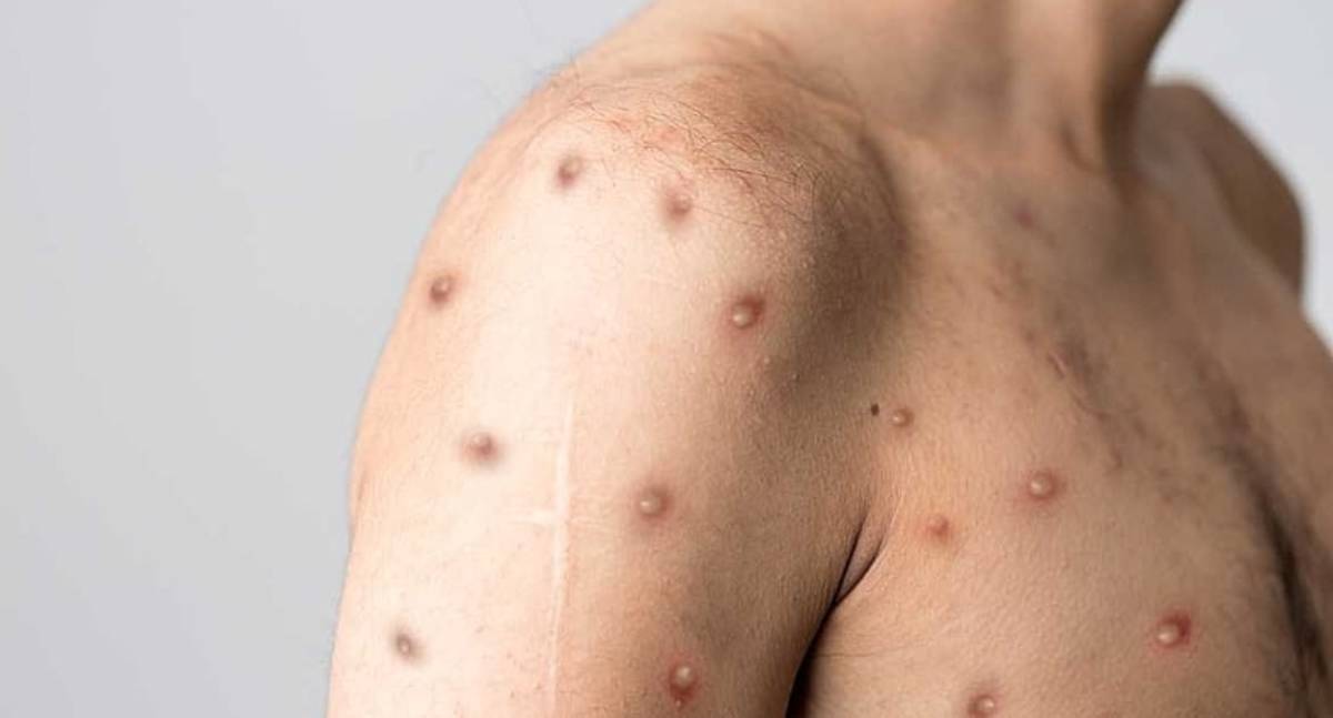 Prefeitura de Jaru orienta população em casos de suspeita de Mpox