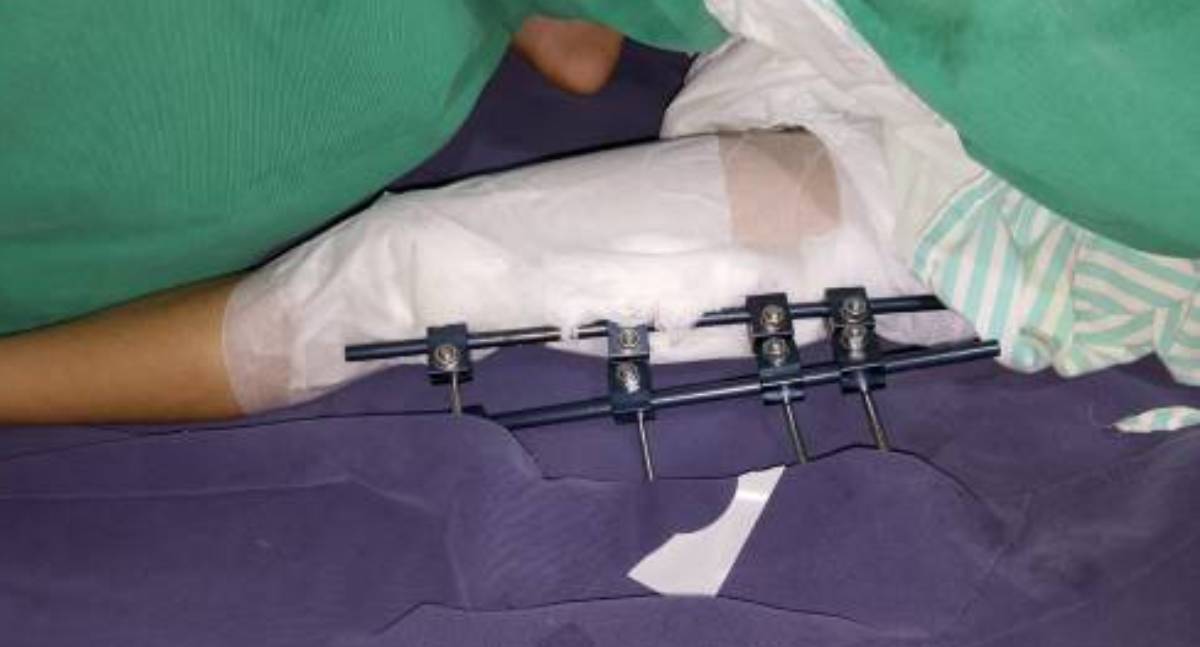 Mãe e filho autista sofrem fraturas graves após acidente em RO