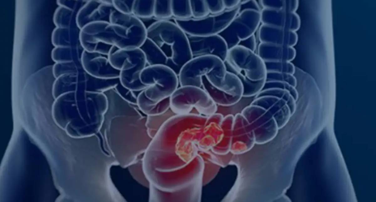 SUS pode implementar programa de rastreamento para câncer colorretal