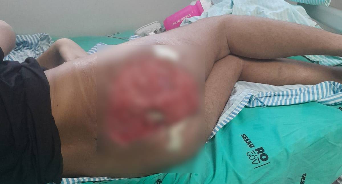 Paciente com necrose profunda aguarda cirurgia e família denuncia negligência em Hospital de Porto Velho