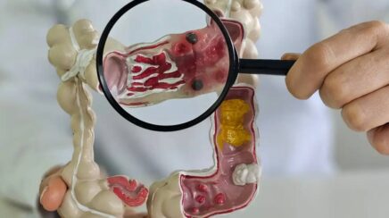 Número de pessoas com doenças inflamatórias intestinais cresce cinco vezes no Brasil