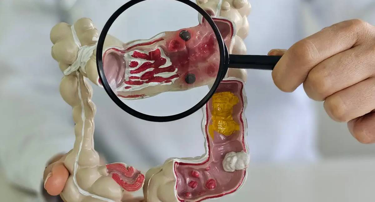 Número de pessoas com doenças inflamatórias intestinais cresce cinco vezes no Brasil