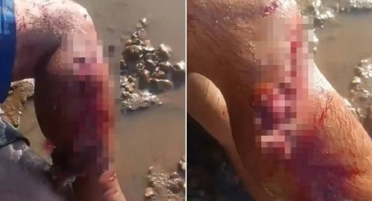 Pescador fica gravemente ferido após ser atacado por jacaré de grande porte no Rio Araguaia