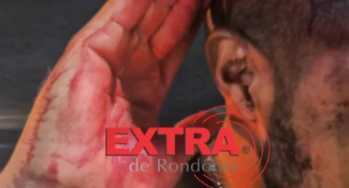 Homem é agredido com taco de sinuca na cabeça durante discussão em bar de RO
